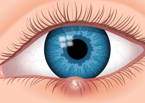 Izrasline oko očiju