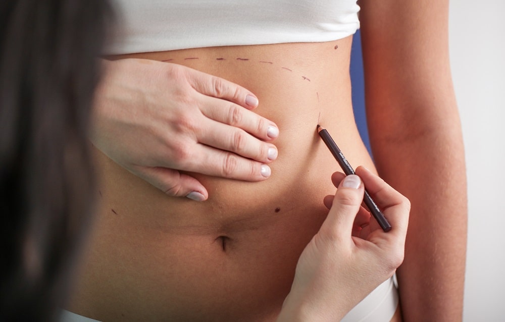 LIPOSUKCIJA-TRBUHA - Poliklinika Medikol