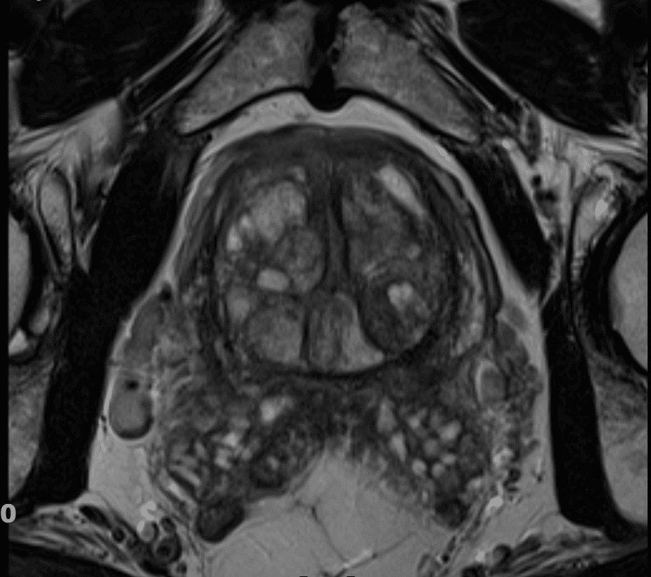 MR-prostate-Medikol - Poliklinika Medikol MR prostate, slikovni prikaz