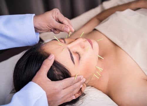 Akupunktura - male iglice velikih mogućnosti