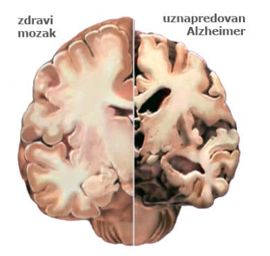mozak-alzheimer-e1569580851271 - Poliklinika Medikol