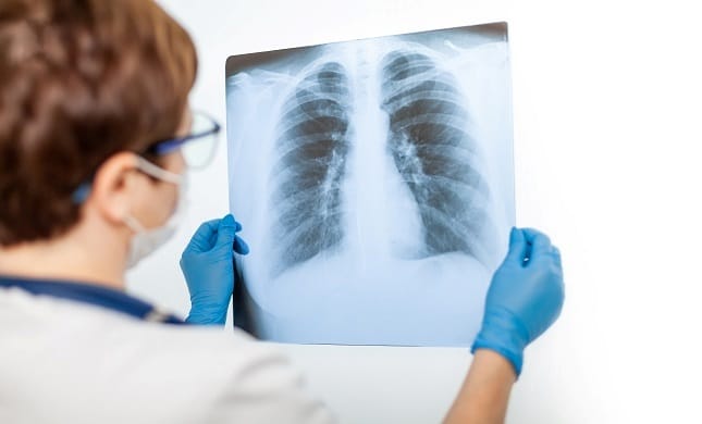 rtg-pluca-2-mala - Poliklinika Medikol digitalni RTG