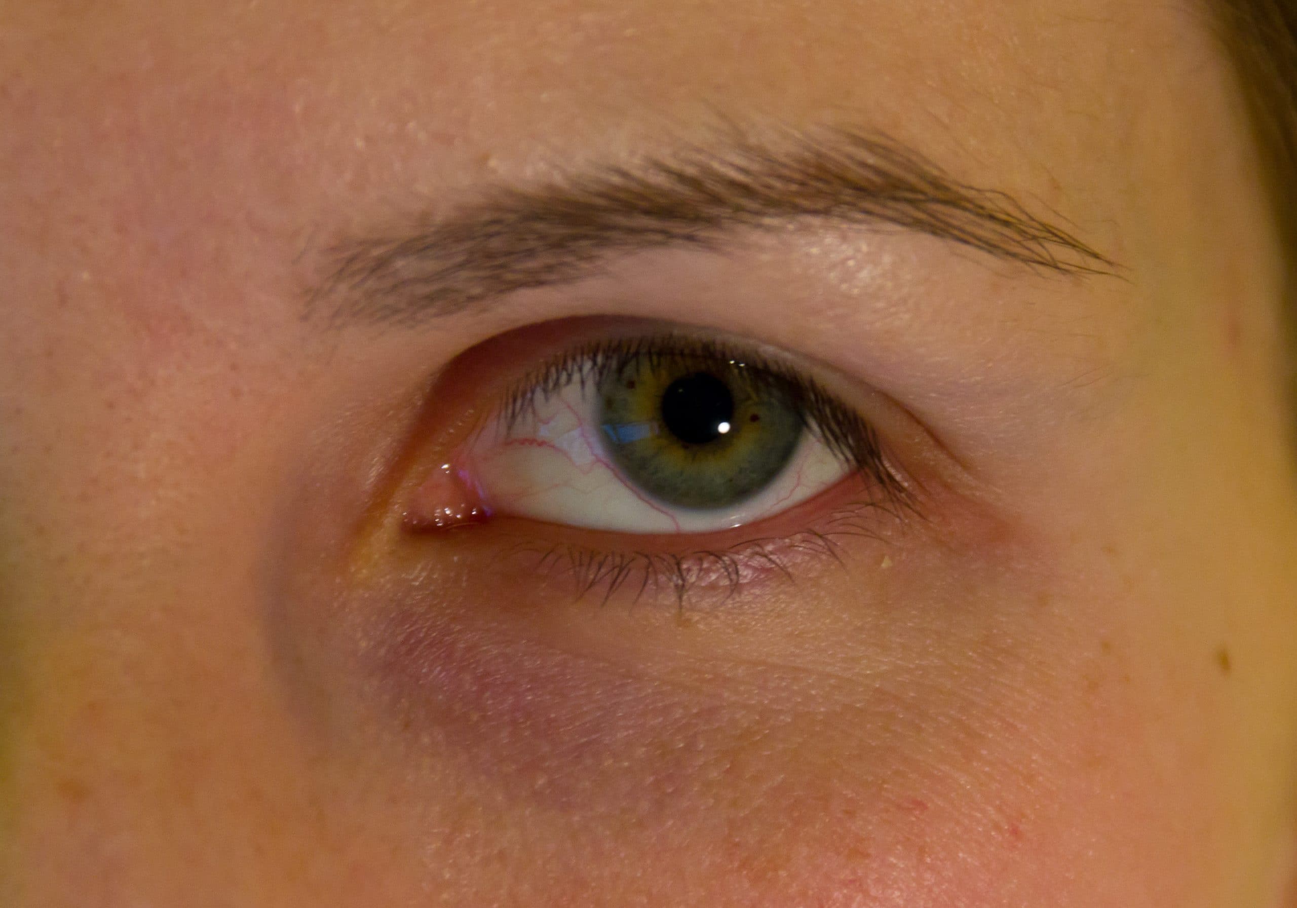 spustena-gornja-vjeda (1) - Poliklinika Medikol blefaroplastika