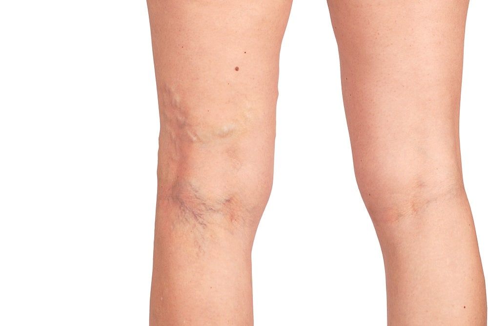 varicose veins on the skin macro close up circulation problem medicine concept - Poliklinika Medikol
