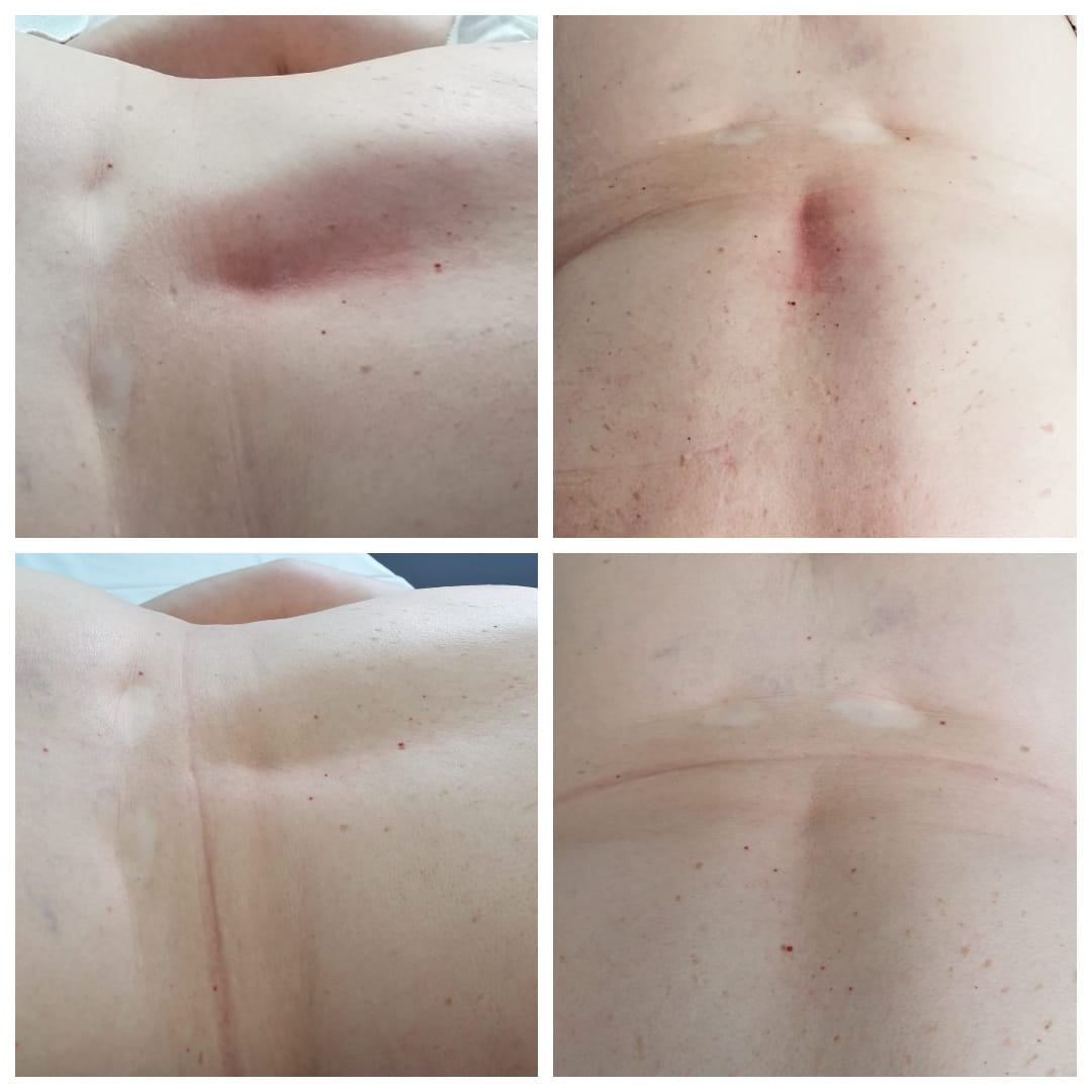 rezultat tehnike miofascijalnog oslobođenja - Poliklinika Medikol rezultat tehnike miofascijalnog oslobođenja