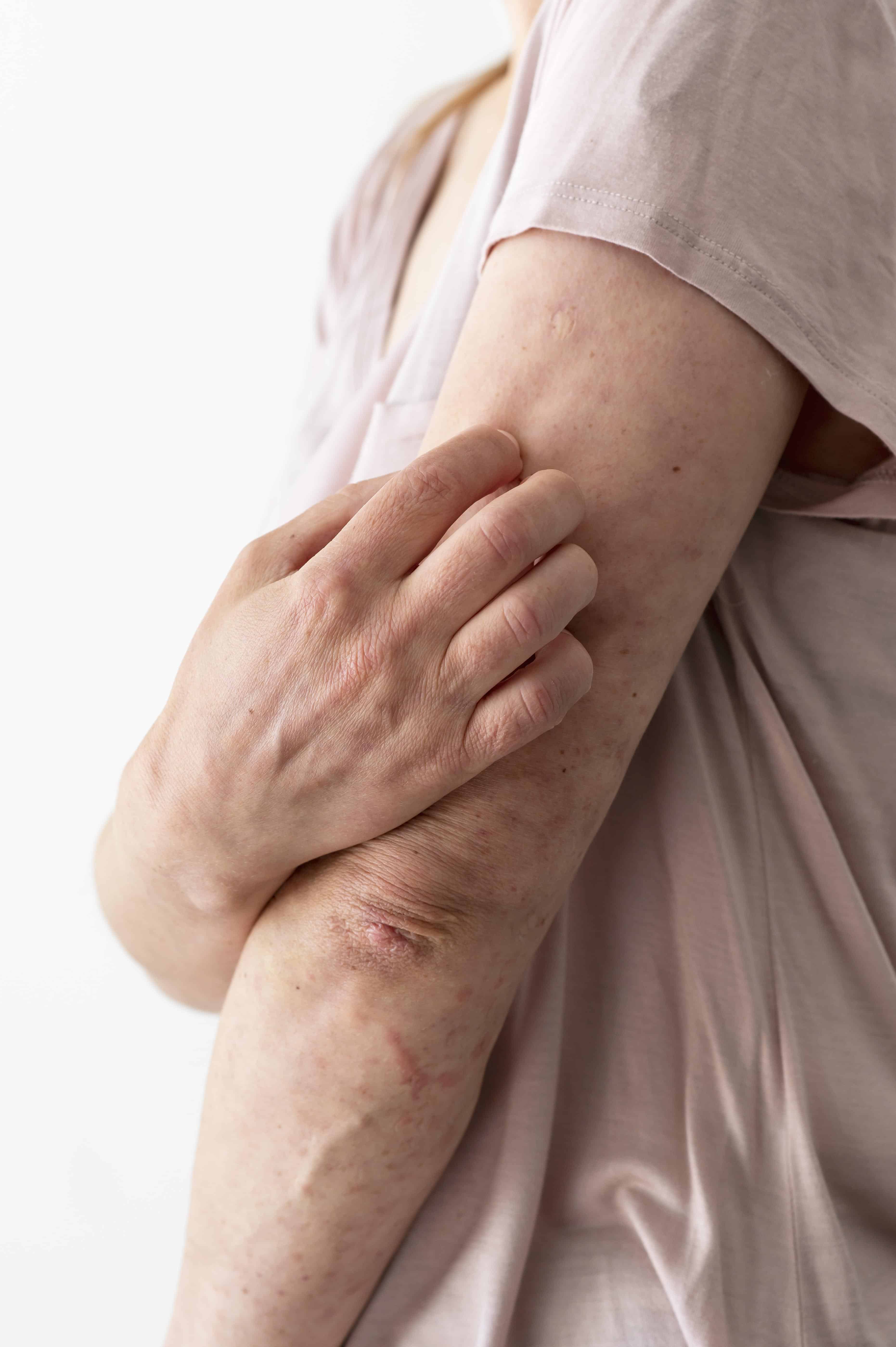 kožna alergija - Poliklinika Medikol