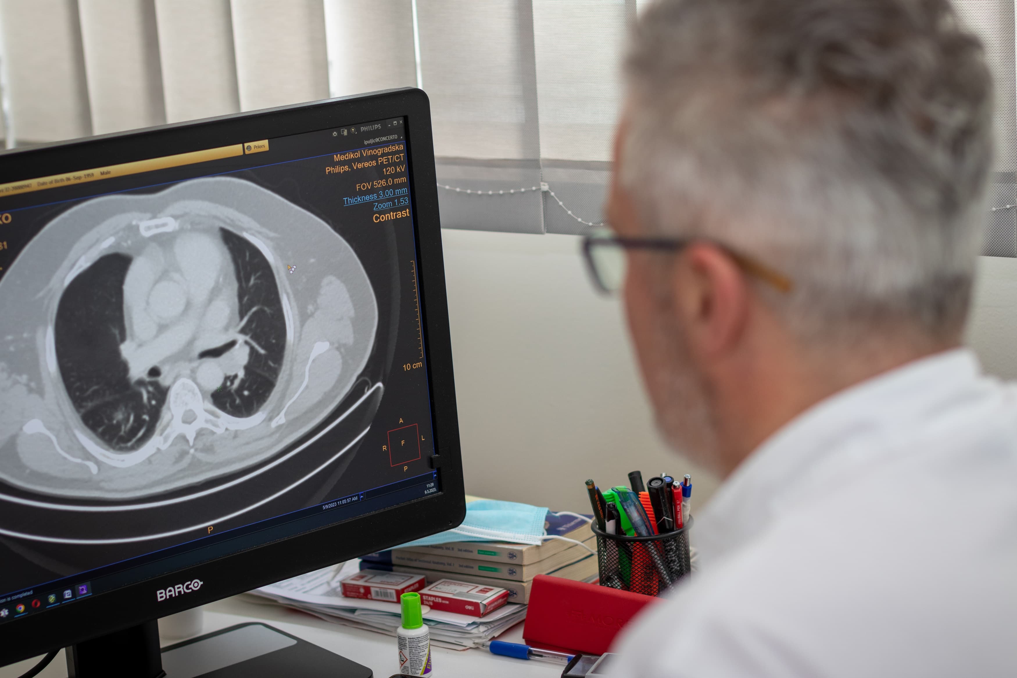 low dose CT pluća - Poliklinika Medikol low dose CT pluća Medikol