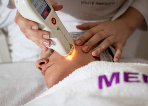 MultiFrax laser za pomlađivanje kože